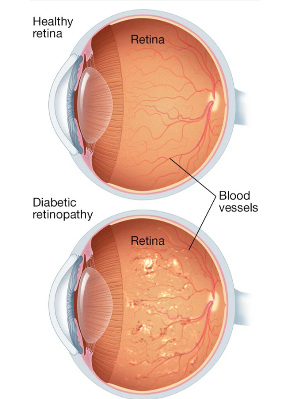 Diabetic retinopathy management