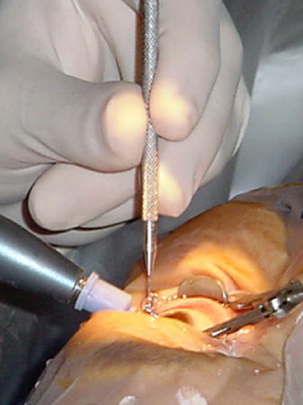 Phacoemulsification cataract surgery with lens Implantation