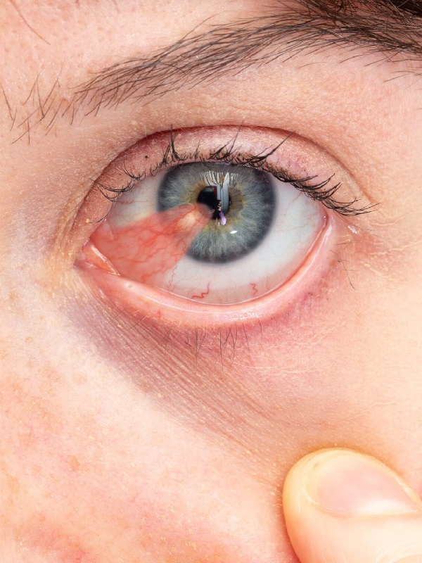 Diagnosis and treatment of corneal diseases